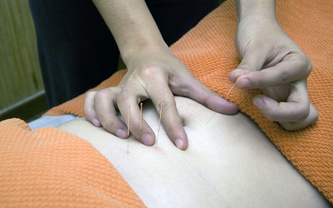 Acupuncture
